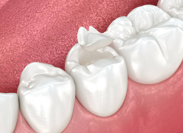 Dental Inlays and Onlays in Bandon, OR